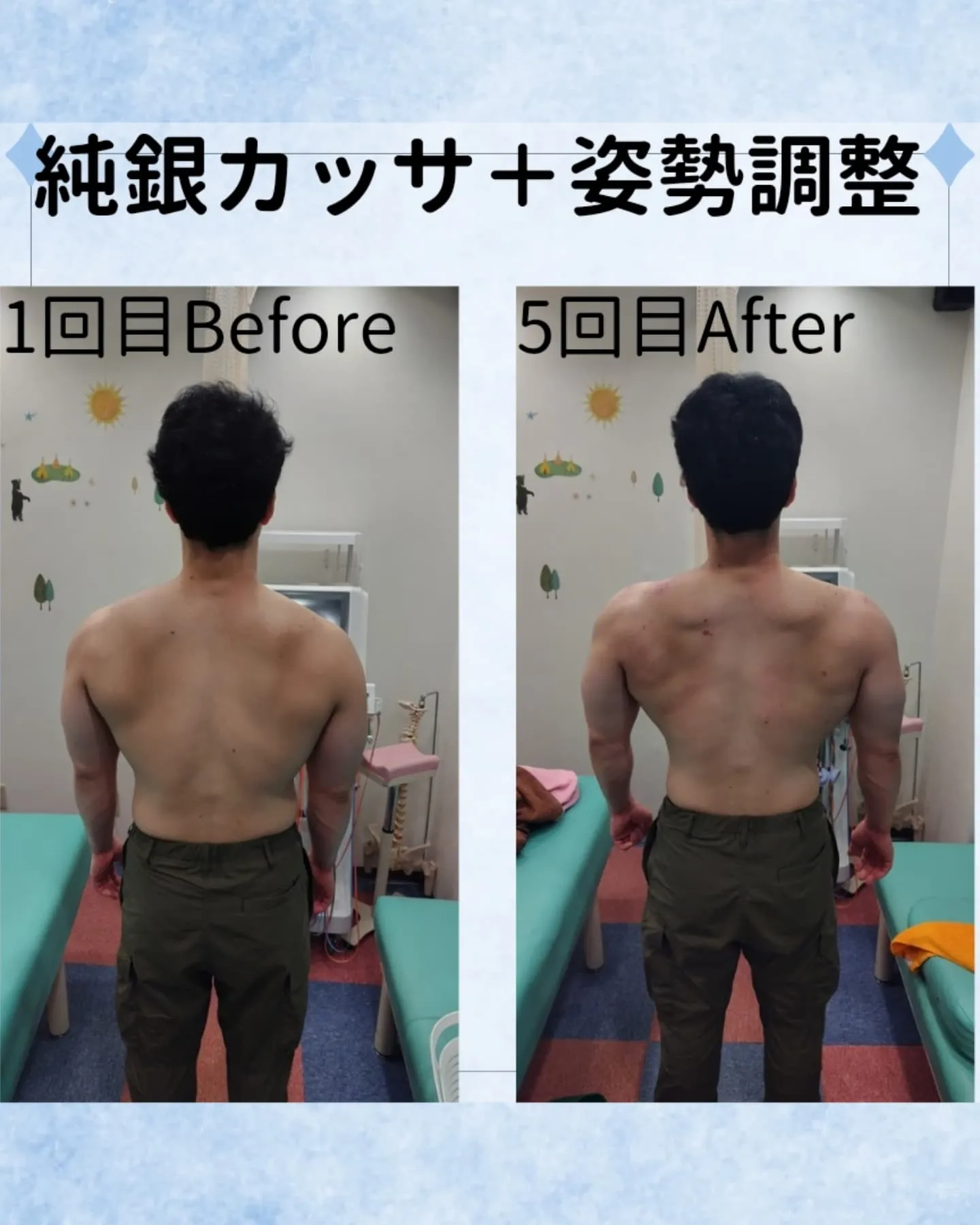 姿勢調整＋純銀カッサのBefore.After